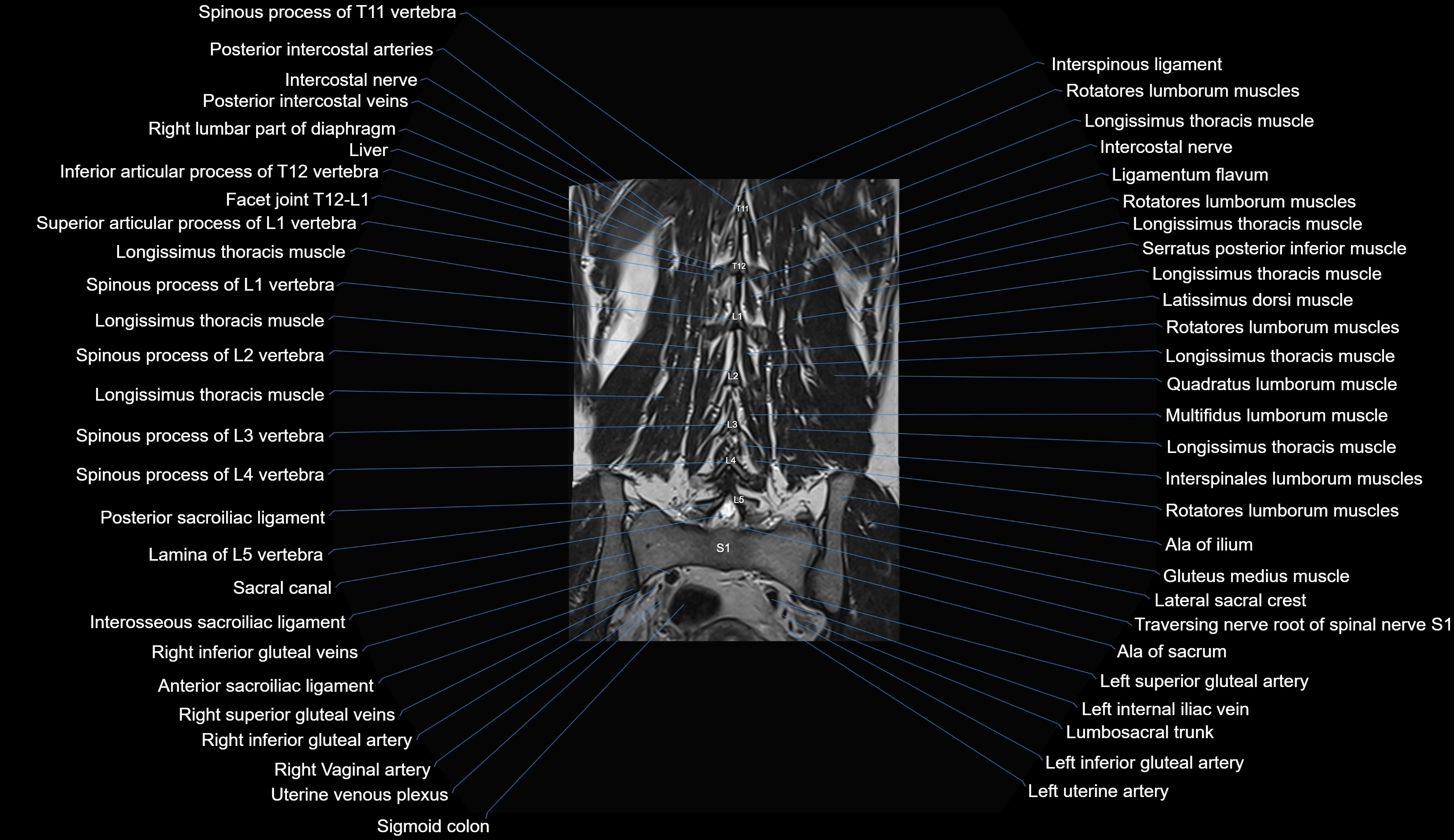 MRI lumbar spine coronal cross sectional anatomy 3T radiology  image-img-00001-00025.webp